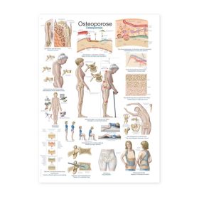Plakat osteoporoza, 70x100cm